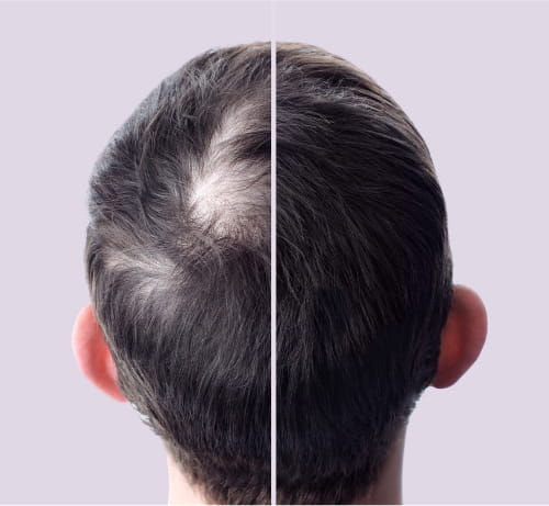 Hair loss improvement.